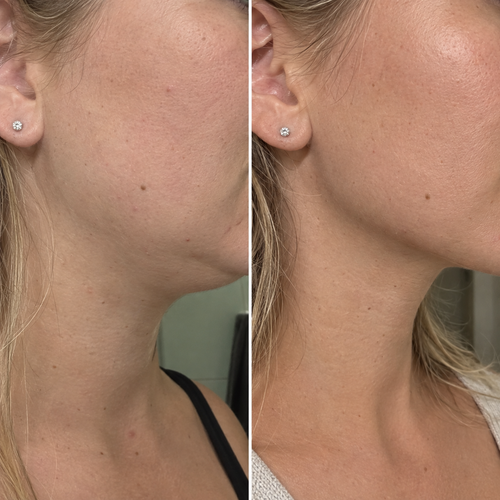 Lymphatic Drainage Massager — "The Gua Shua On Steroids"